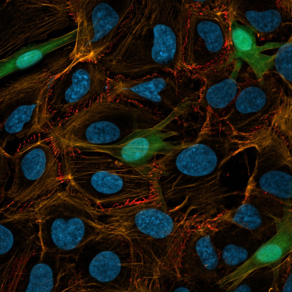 Melanoma cell on brain endothelium Melanoma cell on brain endothelium